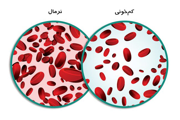رژیم غذایی کم خونی