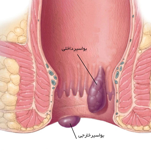 نشانه های بواسیر داخلی و بواسیر خارجی 