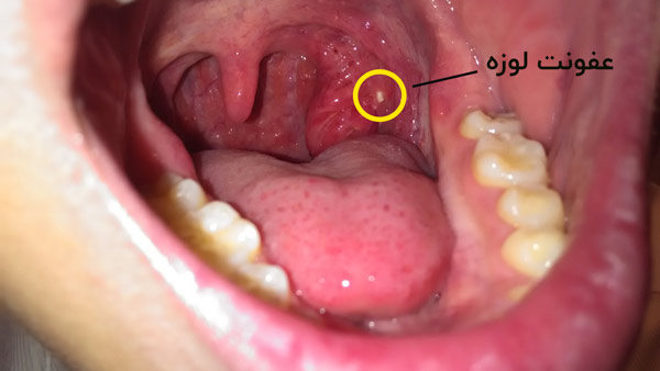 پیشگیری از ایجاد سنگ لوزه