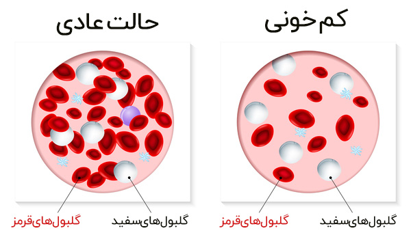 کم‌ خونی یا آنمی چیست