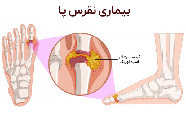 بیماری نقرس پا