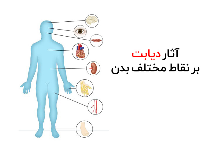عوارض دیابت نوع ۱