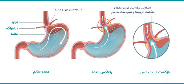 علت رفلاکس معده