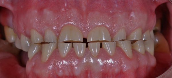 دندان قروچه